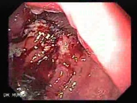 Nawrotowy gruczolakorak żołądka - endoskopia (4 z 4)