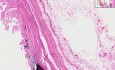 Miażdżyca - histopatologia - aorta
