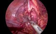Foregut Laparoscopic Esophagogastric Bypass Using Colonic Interposition for Corrosive Esophageal and Gastric Stricture
