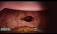 Histerektomia laparoskopowa — animacja zamknięcia mankietu pochwy za pomocą jednokierunkowego szwu kolczastego Quill®