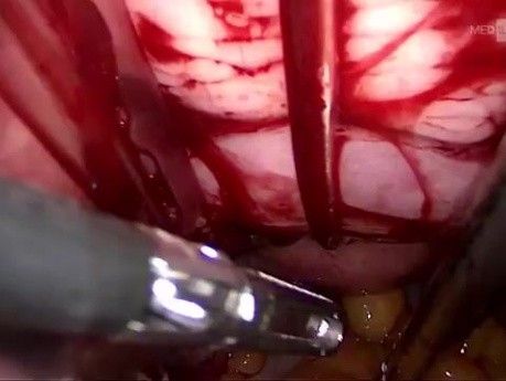 vNOTES – obustronna salpingo-ooforektomia