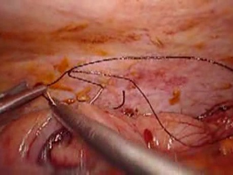 Perforacja okrężnicy z zapaleniem otrzewnej - laparoskopia (13 z 46)