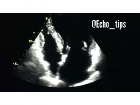 4. Przypadek kardiologiczny - Co widzisz w echokardiografii?