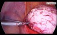 Mięśniak śródścienny- laparoskopowa miomektomia