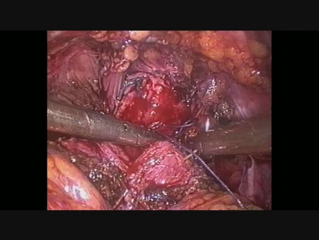 Zespolenie pęcherza z cewką moczową - kolejne szwy - laparoskopowa radykalna prostatektomia