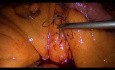 Operacja żołądka metodą Gastric bypass - część 5