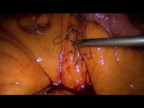 Operacja żołądka metodą Gastric bypass - część 5