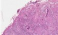 Rak kolczystokomórkowy   