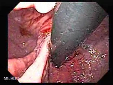 Przełyk Barretta i gruczolakorak połączenia żołądkowo-przełykowego - dwie przepukliny