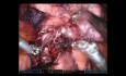 Résection du lobe pulmonaire supérieur gauche assistée par robot