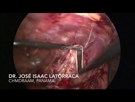 Resekcja laparoskopowa dużej torbieli jamy otrzewnej
