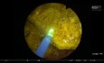 Litotrypsja kamieni pęcherza moczowego przy użyciu lasera