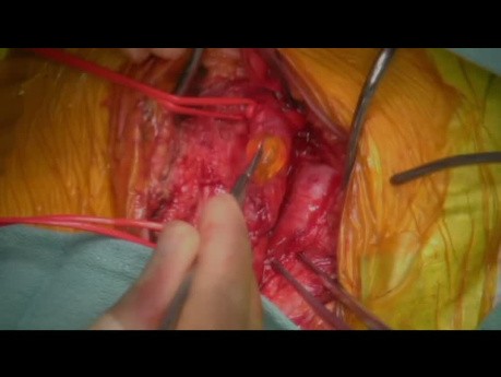 Śluzak lewego przedsionka serca powikłany zatorowością do aorty zstępującej aż do brzusznego rozdwojenia aorty