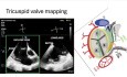Introducción a la ecocardiografía 3D, parte 2: Evaluación de las válvulas mitral, tricúspide, aórtica, CIA y OAI.
