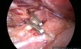 Cholecystektomia laparoskopowa z powodu ostrego zapalenia trzustki w okresie połogu