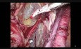 Rak Endometrium
