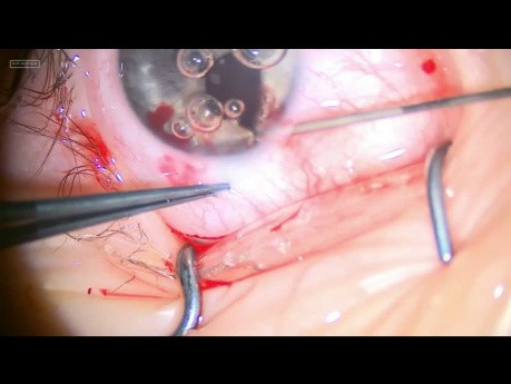 Plastyka wrodzonego, częściowego ubytku tęczówki wykonany u 5-cio letniej pacjentki, z dobrą ostrością wzroku oraz z zachowaną soczewką soczewką własną 