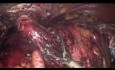 Gastrektomia laparoskopowa u pacjenta po wcześniejszej częściowej resekcji żołądka
