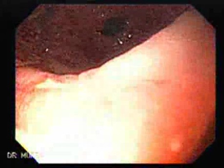 Pierwotny chłoniak żołądka po przeszczepie nerki - wrzody żołądka