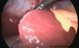 Cholecystektomia laparoskopowa (płat dodatkowy wątroby)
