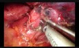 Lobektomia górna lewostronna sposobem VATS z pojedynczego dostępu z resekcją fragmentu ściany klatki piersiowej