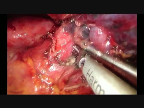 Lobektomia górna lewostronna sposobem VATS z pojedynczego dostępu z resekcją fragmentu ściany klatki piersiowej