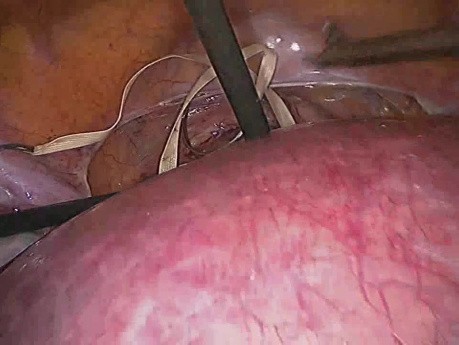 Laparoskopowe zwężenie wewnętrznego ujścia szyjki macicy