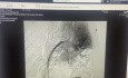 Skuteczna całkowita angiograficzna embolektomia płucna