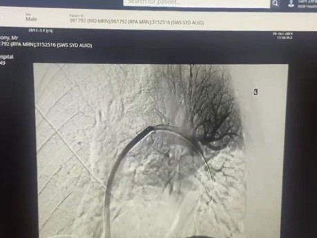 Skuteczna całkowita angiograficzna embolektomia płucna