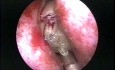 O pochodzeniu zastosowania golarki artroskopowej w endoskopowej chirurgii zatok (film historyczny)