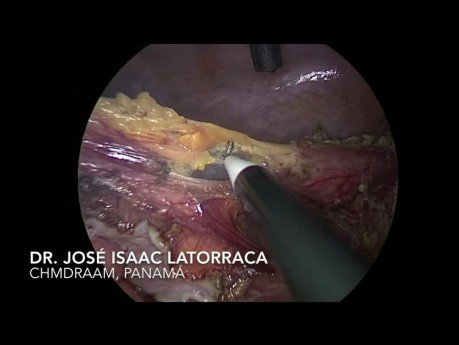 Leczenie laparoskopowe metodą Hartmanna skrętu esicy
