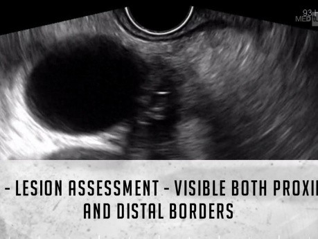 Diagnostyka raka dróg żółciowych z wykorzystaniem ECPW i EUS