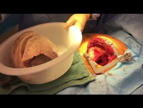 Jednostronny przeszczep płuc z torakotomią przednio-boczną