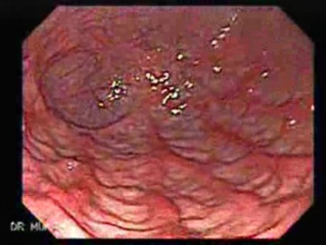 Ostre zapalenie błony śluzowej żołądka. Zaczerwienienie fałdów żołądka