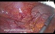 Zastosowanie staplera w appendektomii laparoskopowa