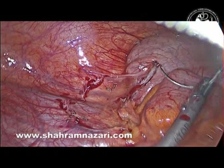 Zastosowanie staplera w appendektomii laparoskopowa