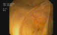 Enterobiosis/ owsica 