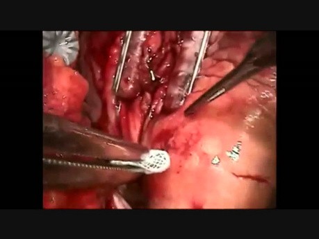 Operacja bypass na bijącym sercu