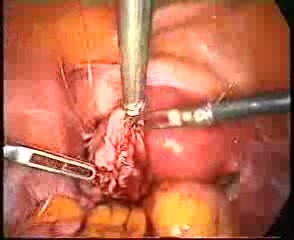 Laparoskopowa chirurgia naprawcza po zabiegu sterylizacji