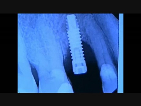 Mikrochirurgia implantologiczna: reparacja nieudanej implantacji