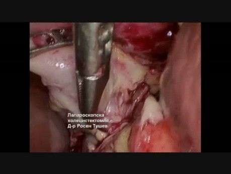 Cholecystektomia laparoskopowa - zgorzel i ropniak pęcherzyka żółciowego