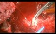 Autotransplantacja serca w przypadku nawracającego mięsaka
