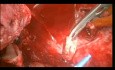 Autotransplantacja serca w przypadku nawracającego mięsaka