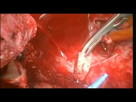 Autotransplantacja serca w przypadku nawracającego mięsaka