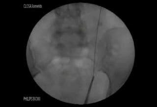 Ureteroskopia i laserowa litotrypsja - wziernikowanie moczowodu i laserowe rozkruszanie kamieni