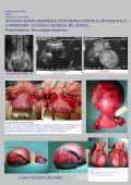 Objawowy mięśniak szyjki macicy - brzuszna histerektomia