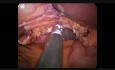 Cholecystektomia laparoskopowa metodą SILS z użyciem systemu Gelpoint i haka przegubowego