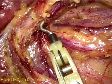 Resekcja guza esicy metodą laparoskopową