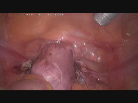SLH - laparoskopowe usunięcie trzonu macicy