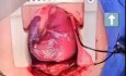 Right coronary Artery on Right Ventricle Outlet in Case of Tetralogy of Fallot